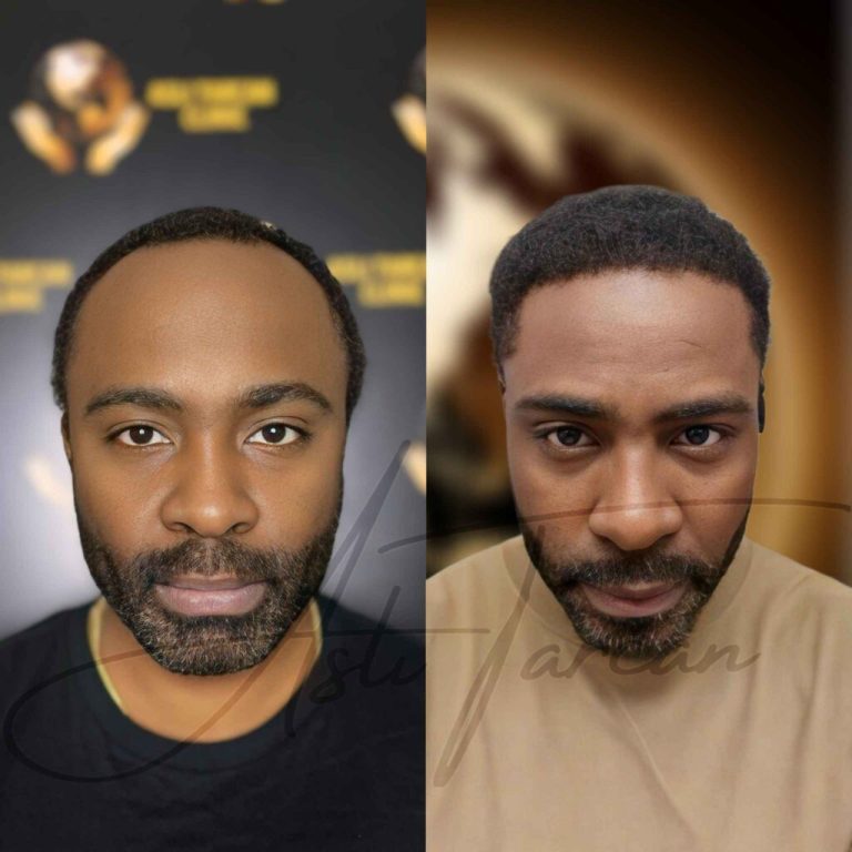 Afro-Haartransplantation-Turkei-vorher-nachher-1024x1024