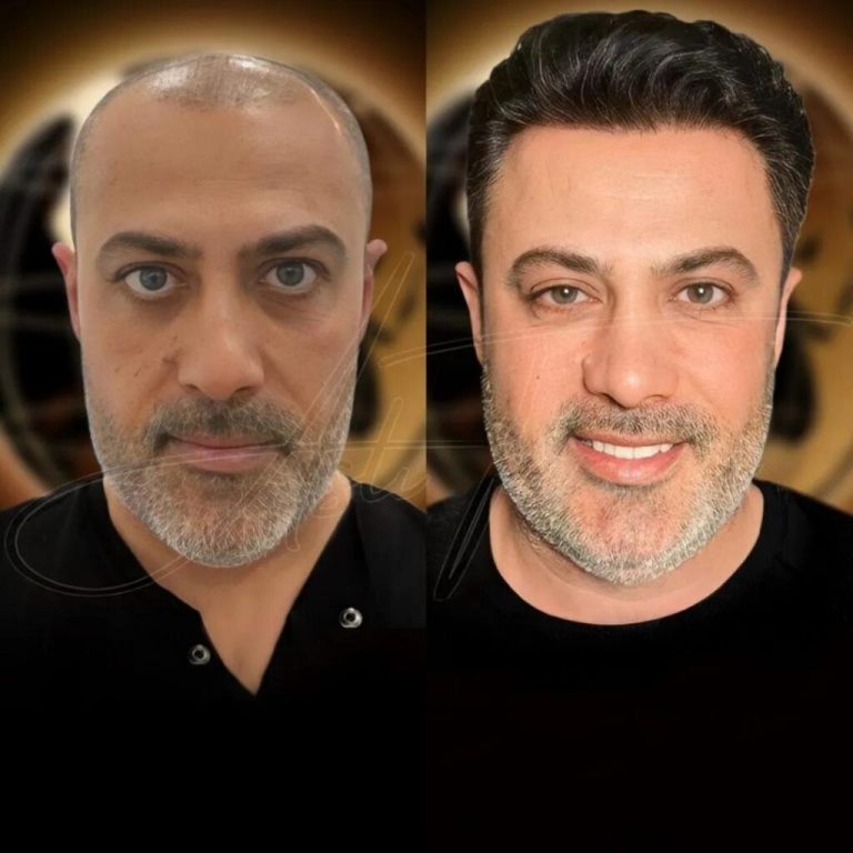 Best-Hair-transplant-Turkey-before-and-after-4-1024x1024