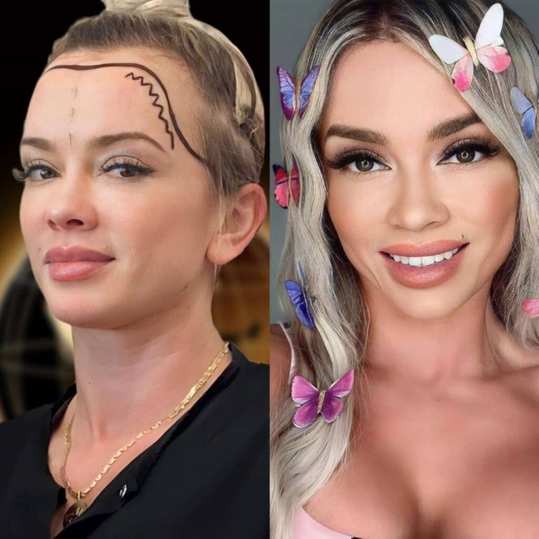 Haartransplantation-Turkei-Frauen-vorher-nachher-1024x1024