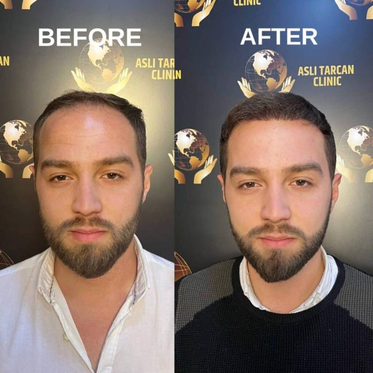 Top-10-Best-Hair-transplant-turkey-before-and-after-1024x1024