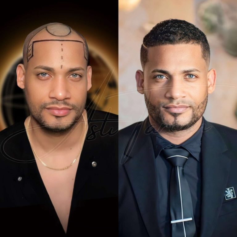 Top-5-Best-Hair-transplant-Turkey-before-and-after-1024x1024