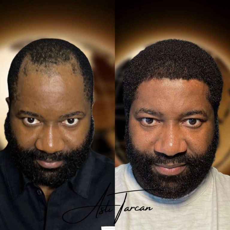 Top-5-best-afro-hair-transplant-turkey-1-1024x1024