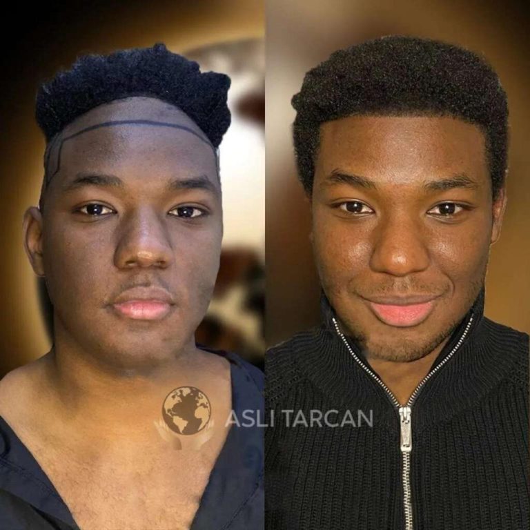 best-afro-hair-transplant-before-and-after-1-1024x1024